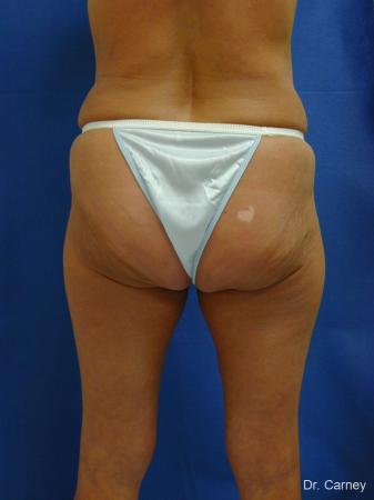 Virginia Beach Liposuction 1213 - After Image 4