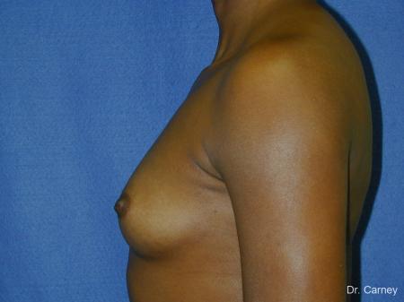Virginia Beach Breast Augmentation 1085 - Before Image 1