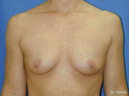 Virginia Beach Breast Augmentation 1081 - Before and After Image 3