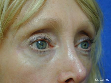 Virginia Beach Eyelid Lift 1079 - After Image 2