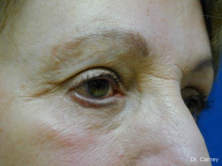 Virginia Beach Facelift 1133 - After Image 3