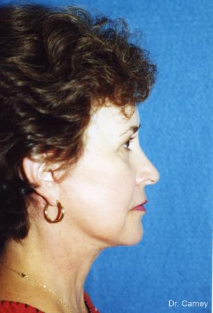 Virginia Beach Facelift 1134 - After Image 2