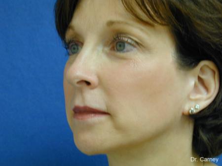 Virginia Beach Brow Lift 1217 - After Image 4
