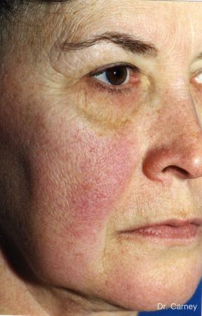 Virginia Beach Facelift 1134 - Before and After 3