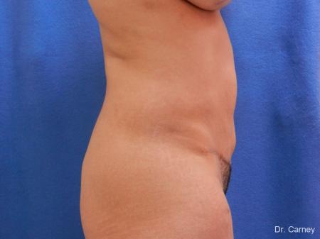 Abdominoplasty: Patient 2 - After Image 1