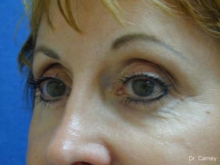Virginia Beach Eyelid Lift 1131 - After Image 3
