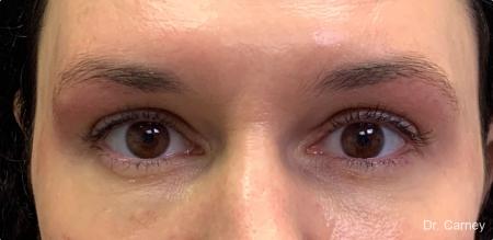Microblading: Patient 1 - Before Image 1