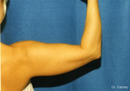 Virginia Beach Brachioplasty 1141 - Before and After Image 2
