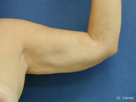 Virginia Beach Brachioplasty 1144 - After Image 1