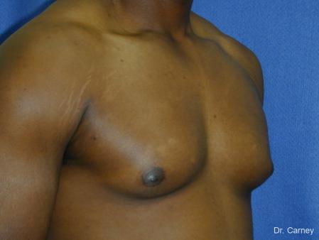 Virginia Beach Gynecomastia 1226 - Before Image 2