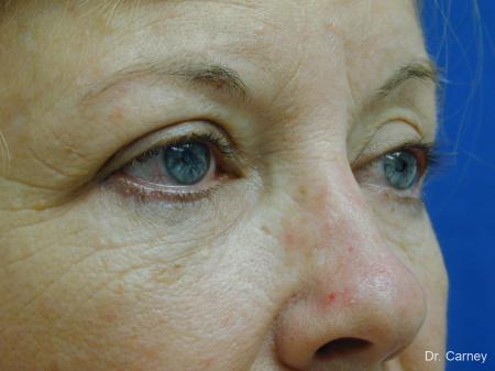Virginia Beach Laser Skin Resurfacing Face 1263 - Before Image 1