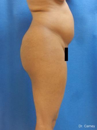 Brazilian Butt Lift: Patient 6 - Before and After Image 5