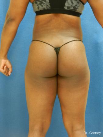 Brazilian Butt Lift: Patient 3 - After Image 5