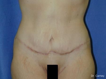 Virginia Beach Tummy Tuck 1249 - After Image 2