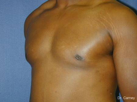 Virginia Beach Gynecomastia 1226 - After Image 3