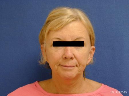 Virginia Beach Brow Lift 1266 - Before and After Image 5