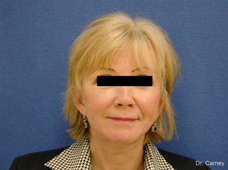Virginia Beach Brow Lift 1266 - After Image 5