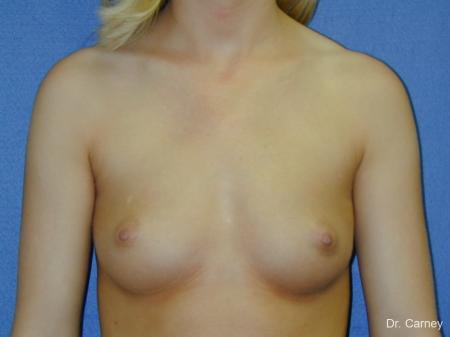 Virginia Beach Breast Augmentation 1092 - Before and After Image 3