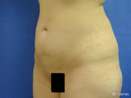Tummy Tuck: Patient 1 - Before Image 2