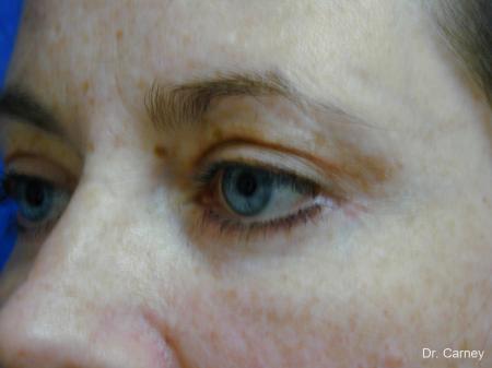 Virginia Beach Eyelid Lift 1138 - After Image 3