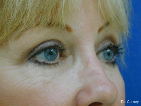 Virginia Beach Laser Skin Resurfacing Face 1263 - After Image 1