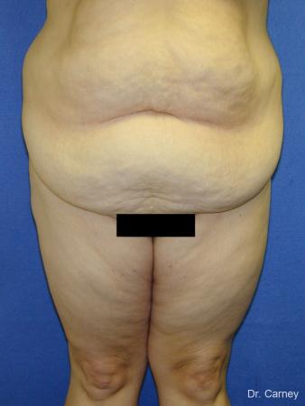 Virginia Beach Thigh Lift 1253 - Before Image 1