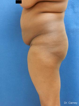 Brazilian Butt Lift: Patient 5 - Before Image 1
