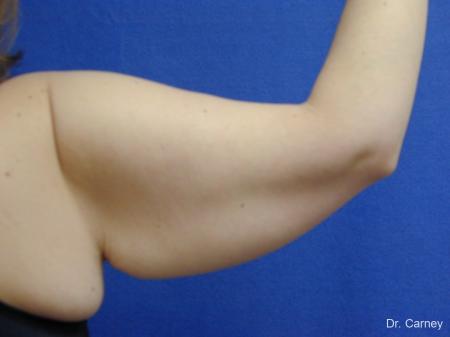 Virginia Beach Brachioplasty 1140 - Before Image 2