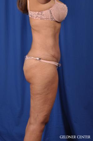 Lipoabdominoplasty: Patient 5 - After Image 3