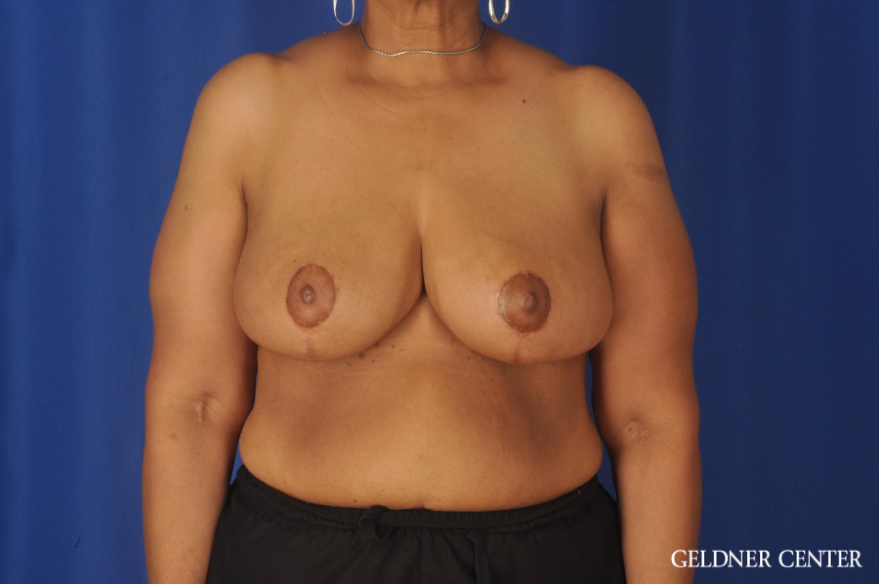 Breast Reduction: Patient 25 - After 