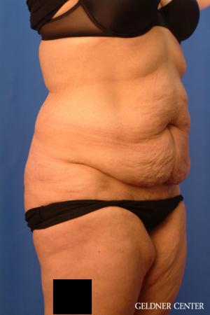 Tummy Tuck: Patient 19 - Before 2