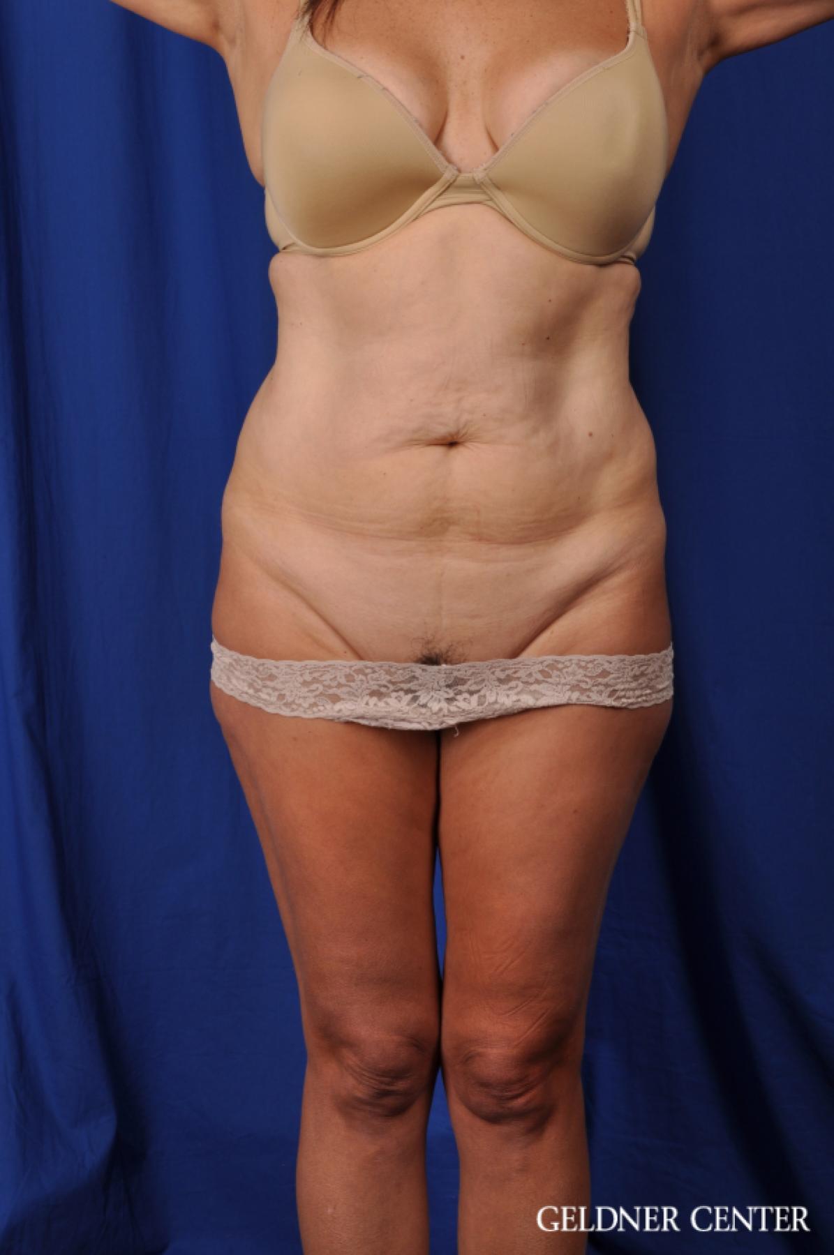 Liposuction: Patient 43 - Before 