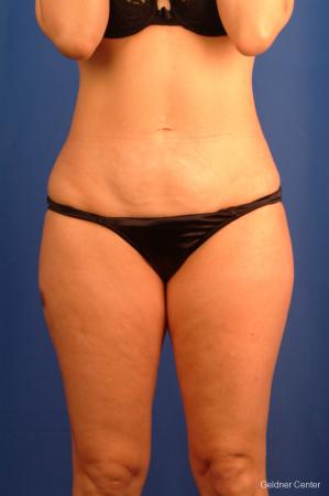 Vaser lipo patient 2520 before and after photos - After Image 1