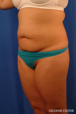 Liposuction: Patient 46 - Before and After 4