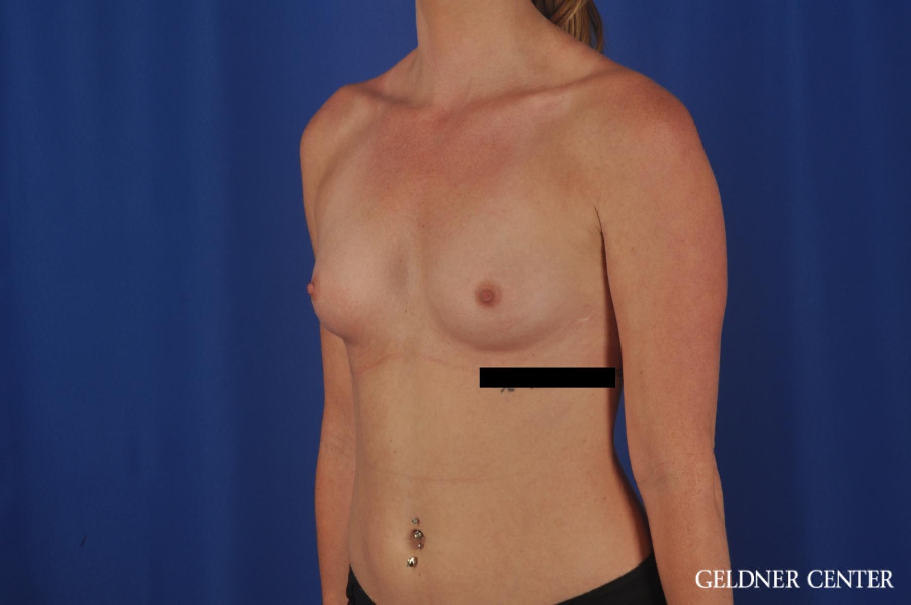 Breast Augmentation Lake Shore Dr, Chicago 6658 - Before and After 4
