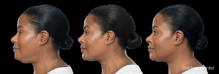 Kybella: Patient 3 - Before and After  