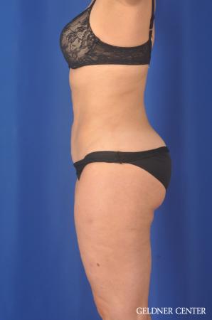 Liposuction: Patient 32 - After 4
