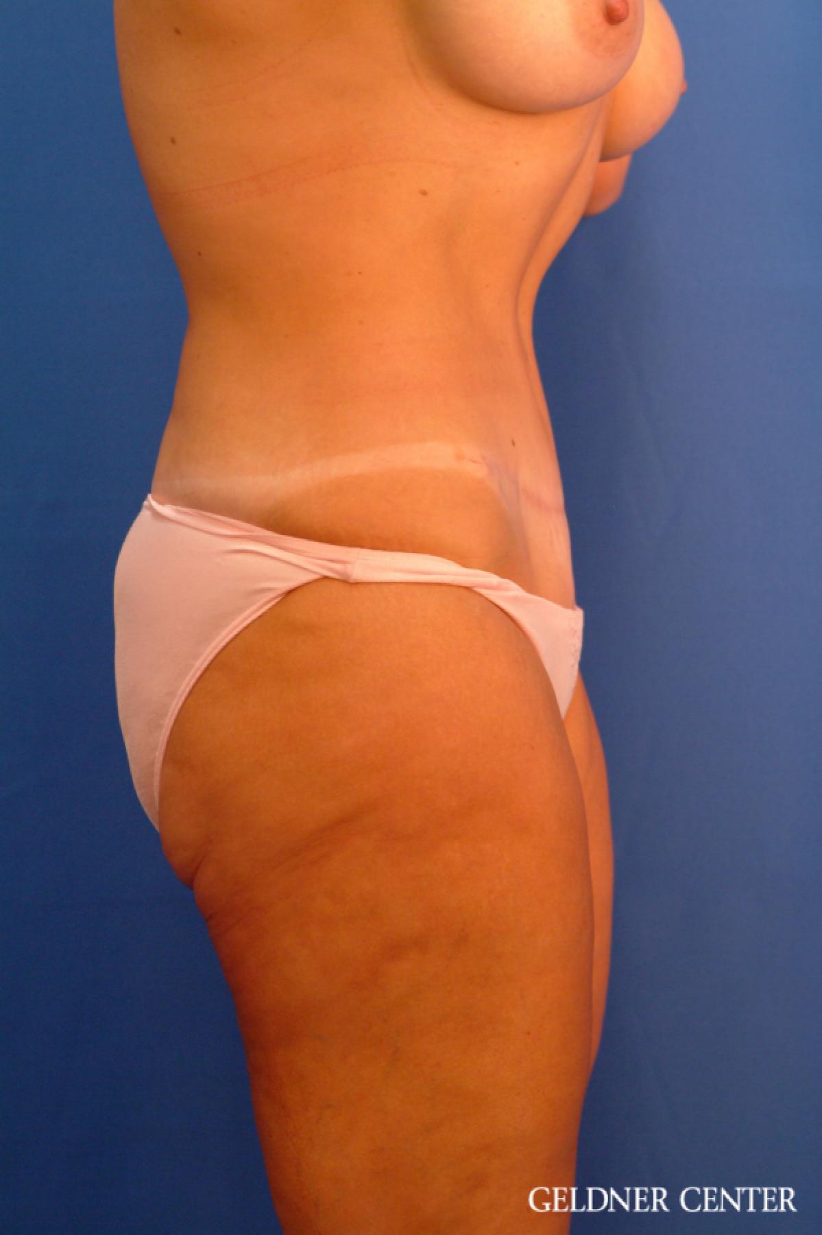 Tummy Tuck: Patient 17 - After 2
