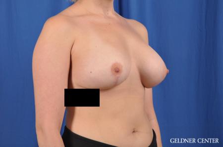 Complex Breast Augmentation: Patient 34 - After 2