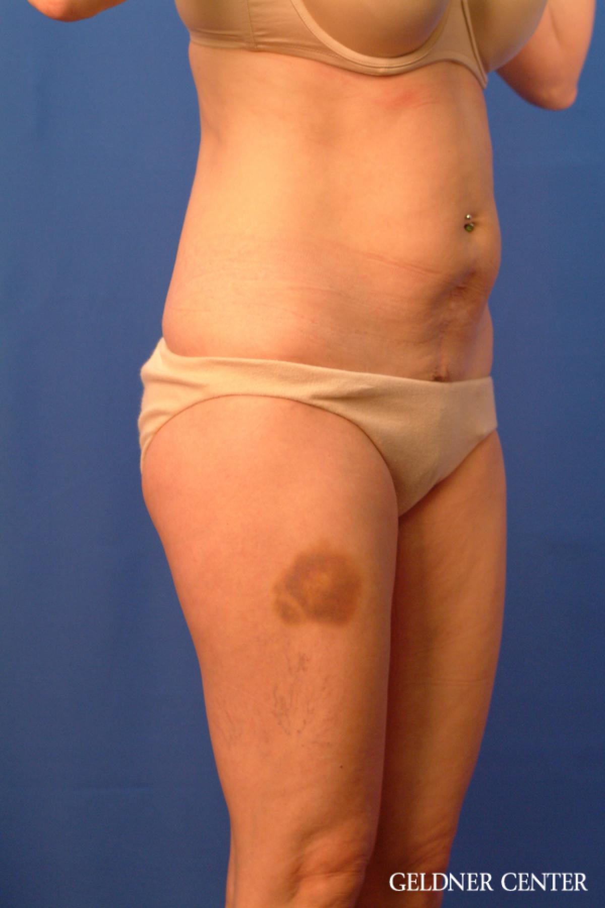 Tummy Tuck: Patient 36 - Before 2