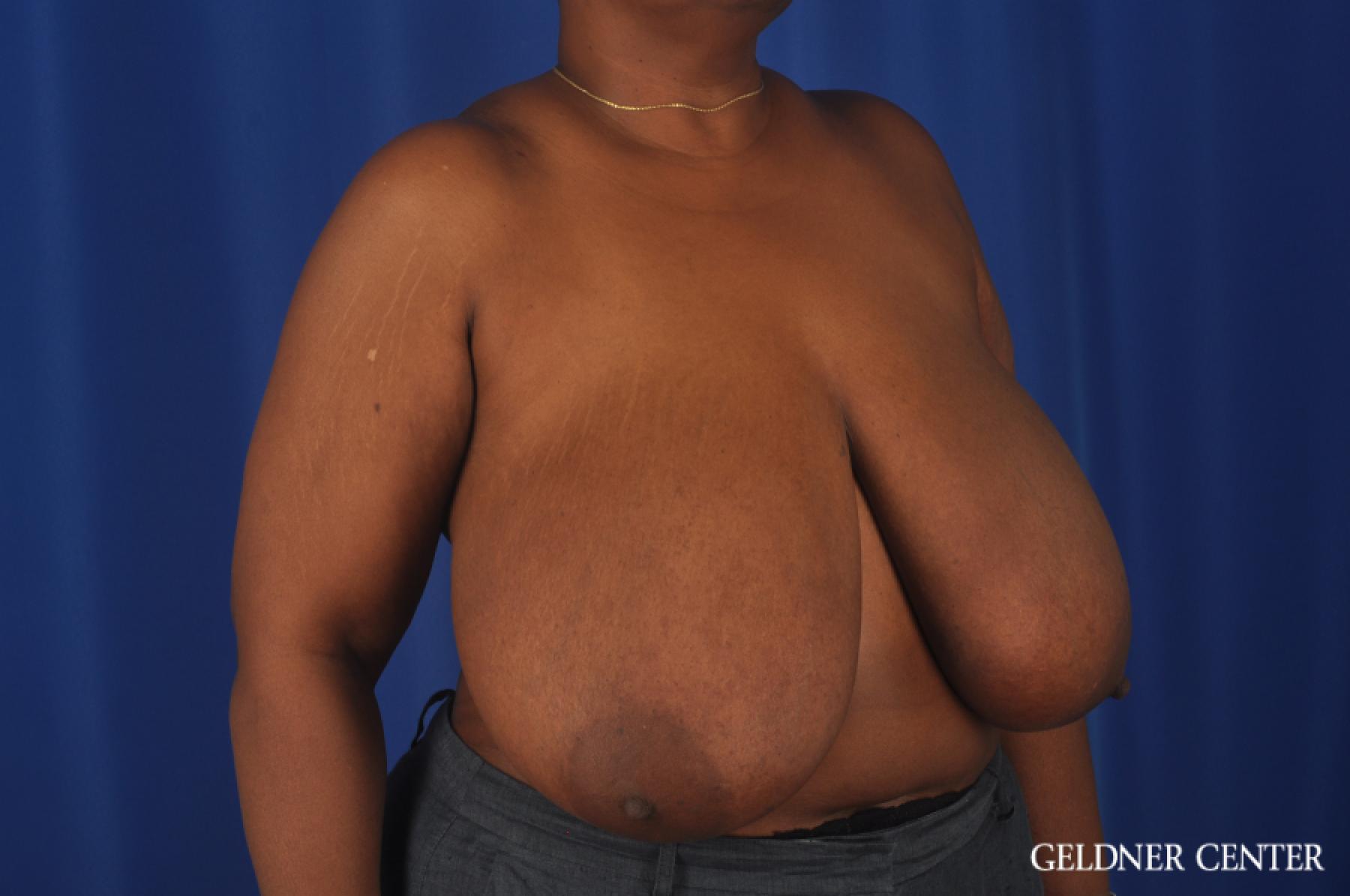 Chicago Breast Reduction 11871 - Before 2