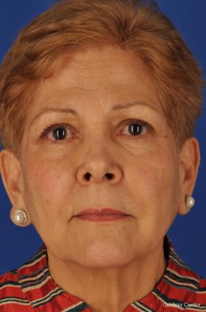 Neck Lift: Patient 1 - Before Image 1