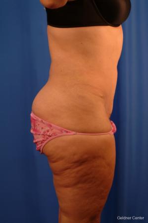 Lipoabdominoplasty: Patient 3 - After Image 2