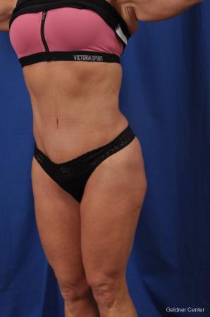 Abdominoplasty: Patient 7 - After Image 4