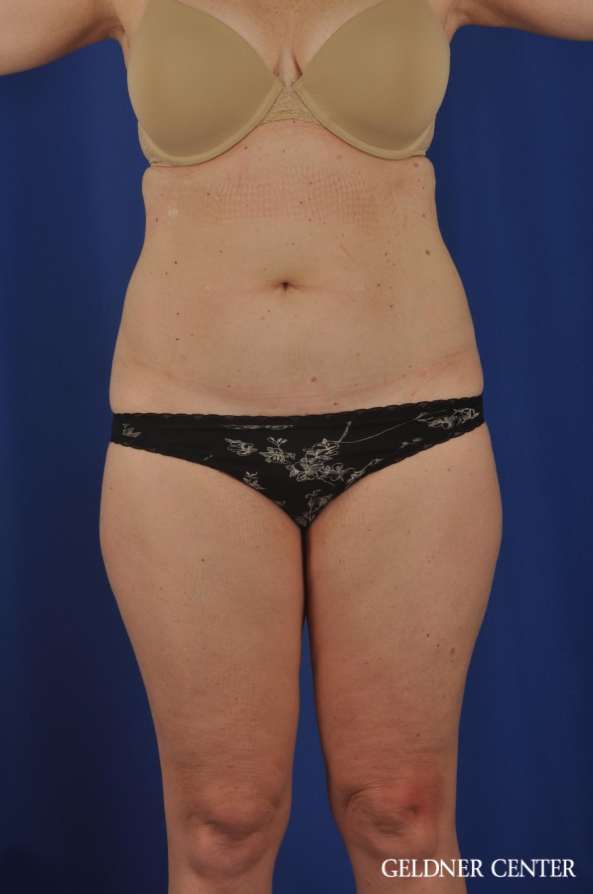 Tummy Tuck: Patient 22 - Before 