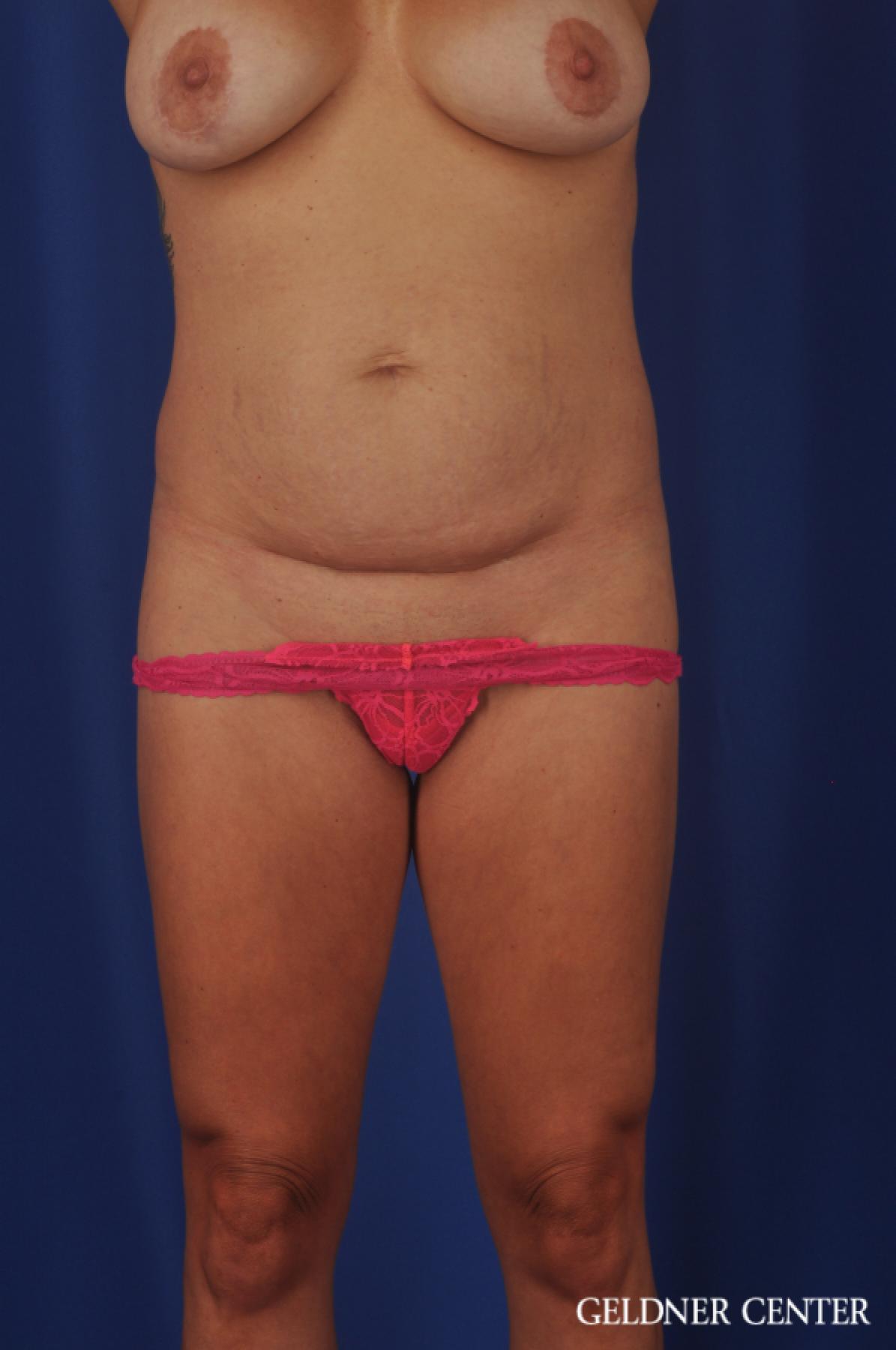 Liposuction: Patient 39 - Before 