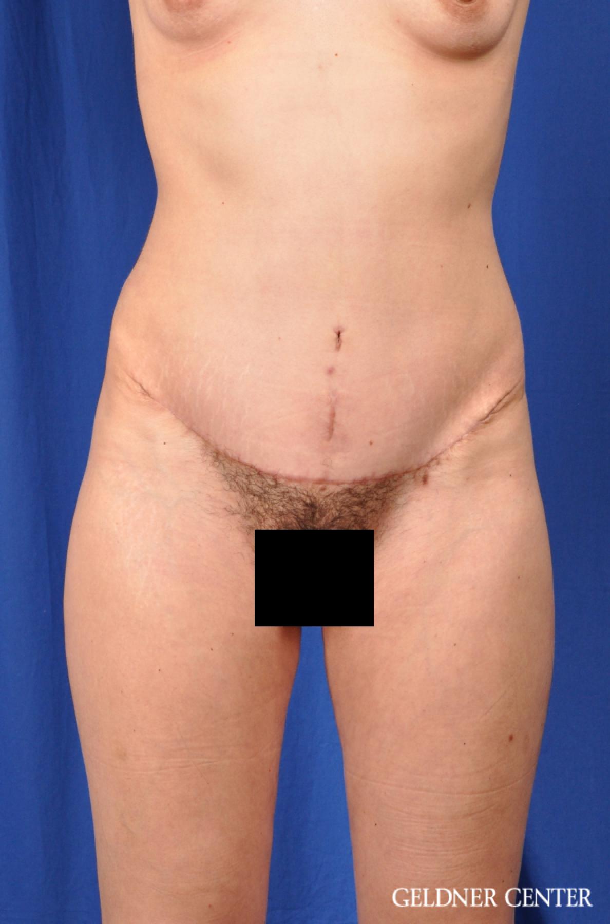 Tummy Tuck: Patient 32 - After 1