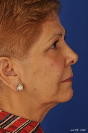 Neck Lift: Patient 1 - Before Image 2