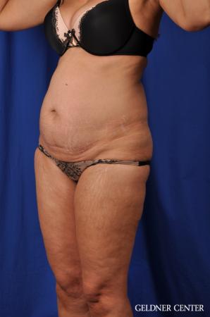 Lipoabdominoplasty: Patient 5 - Before and After Image 4