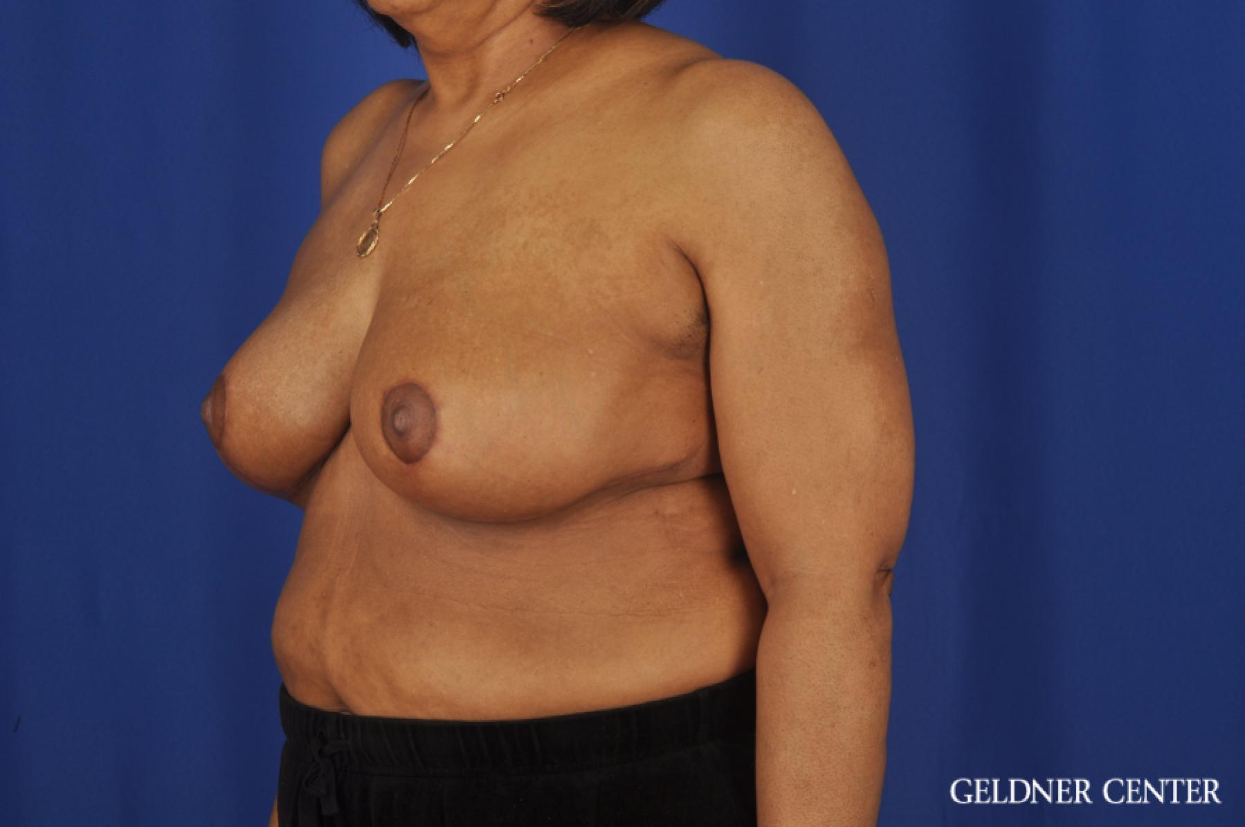 Breast Reduction: Patient 35 - After 4